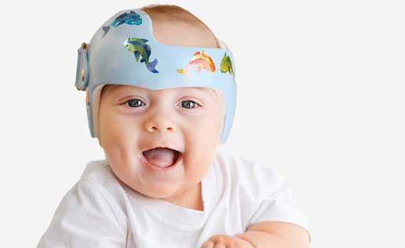 plagiocephaly treatment phoenix az