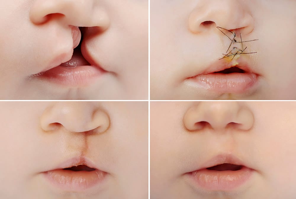 cleft-lip-palate